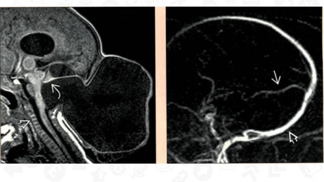 【PPT】One Disease:Chiari 3 【PPT】One Disease:Chiari 3