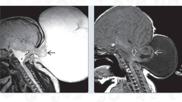 【PPT】One Disease:Chiari 3 【PPT】One Disease:Chiari 3