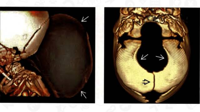 【PPT】One Disease:Chiari 3 【PPT】One Disease:Chiari 3