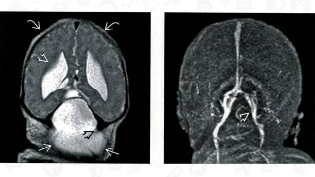 【PPT】One Disease:Chiari 3 【PPT】One Disease:Chiari 3