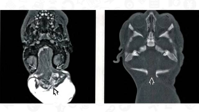 【PPT】One Disease:Chiari 3 【PPT】One Disease:Chiari 3