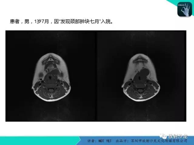 【病例】甲状舌管囊肿1例MR影像表现