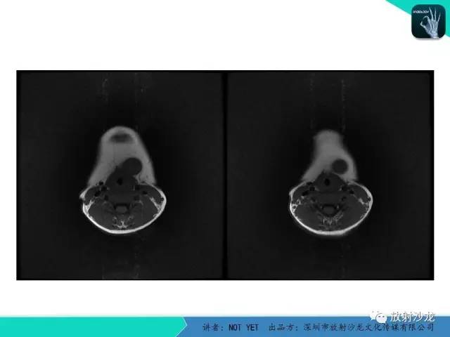 【病例】甲状舌管囊肿1例MR影像表现