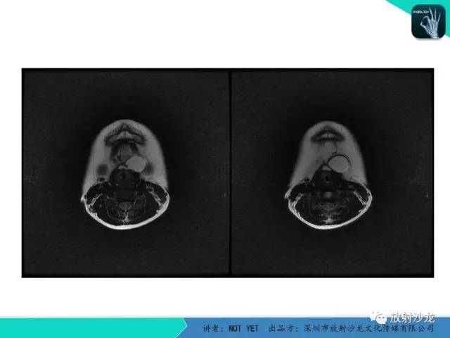【病例】甲状舌管囊肿1例MR影像表现