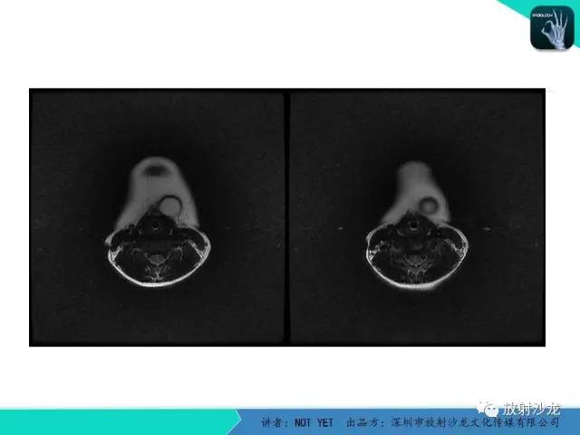 【病例】甲状舌管囊肿1例MR影像表现
