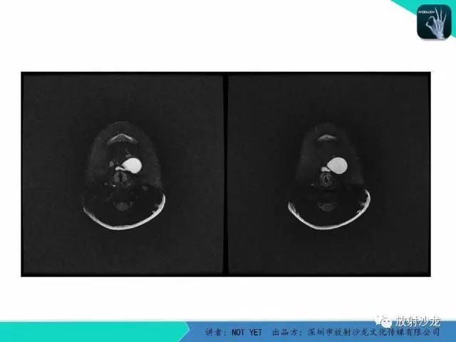 【病例】甲状舌管囊肿1例MR影像表现
