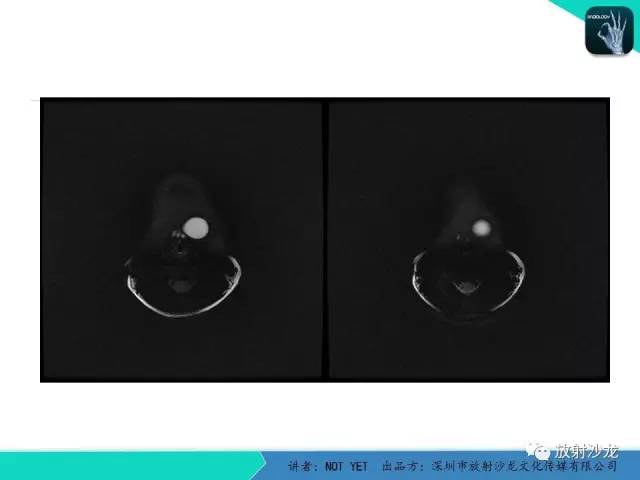 【病例】甲状舌管囊肿1例MR影像表现