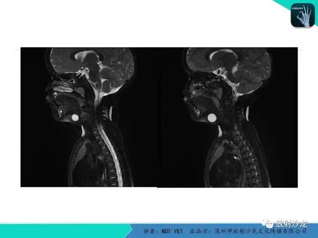 【病例】甲状舌管囊肿1例MR影像表现