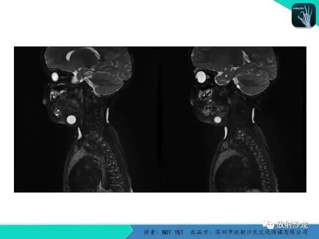 【病例】甲状舌管囊肿1例MR影像表现