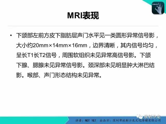 【病例】甲状舌管囊肿1例MR影像表现