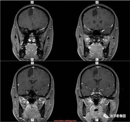 【病例】右额叶少突星形细胞瘤伴囊变1例MR 【病例】右额叶少突星形细胞瘤伴囊变1例MR