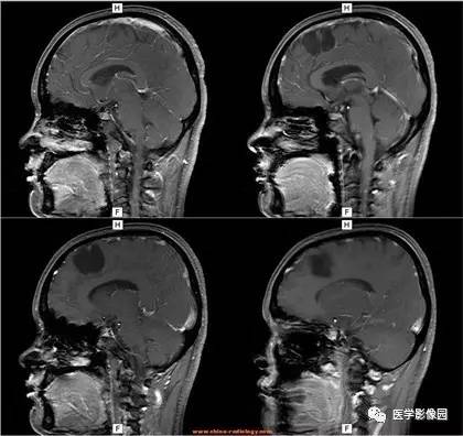 【病例】右额叶少突星形细胞瘤伴囊变1例MR 【病例】右额叶少突星形细胞瘤伴囊变1例MR