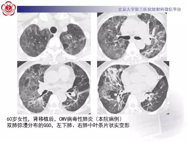 【PPT】磨玻璃密度病变的CT诊断（二）