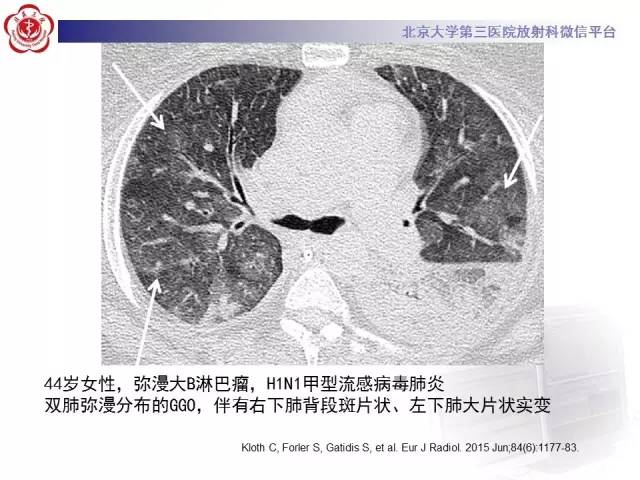 【PPT】磨玻璃密度病变的CT诊断（二）