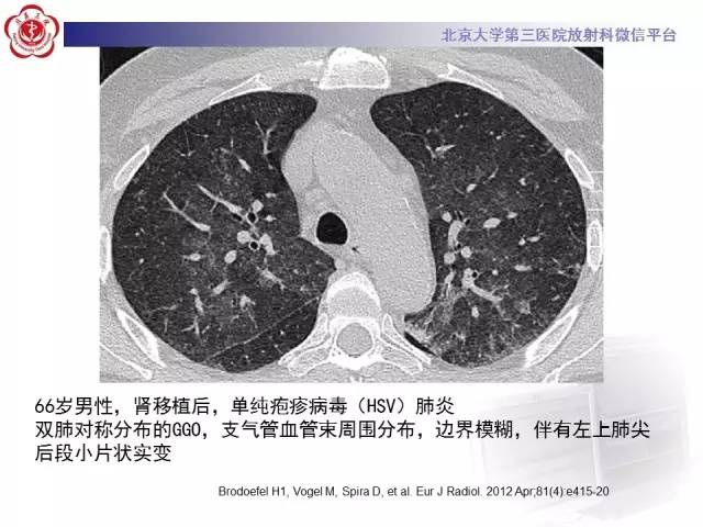 【PPT】磨玻璃密度病变的CT诊断（二）