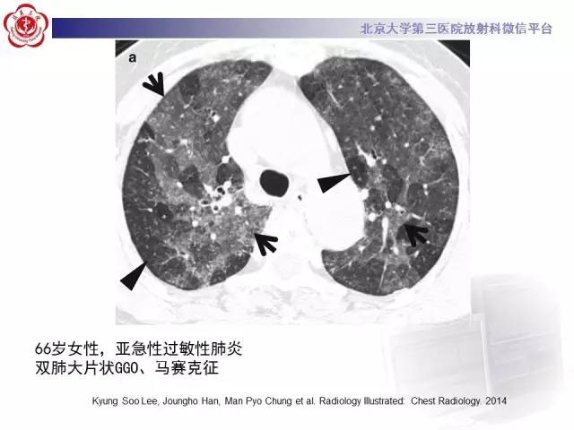 【PPT】磨玻璃密度病变的CT诊断（二）