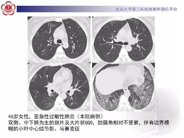 【PPT】磨玻璃密度病变的CT诊断（二）