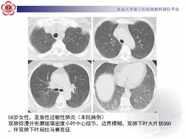 【PPT】磨玻璃密度病变的CT诊断（二）