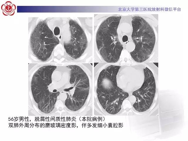 【PPT】磨玻璃密度病变的CT诊断（二）