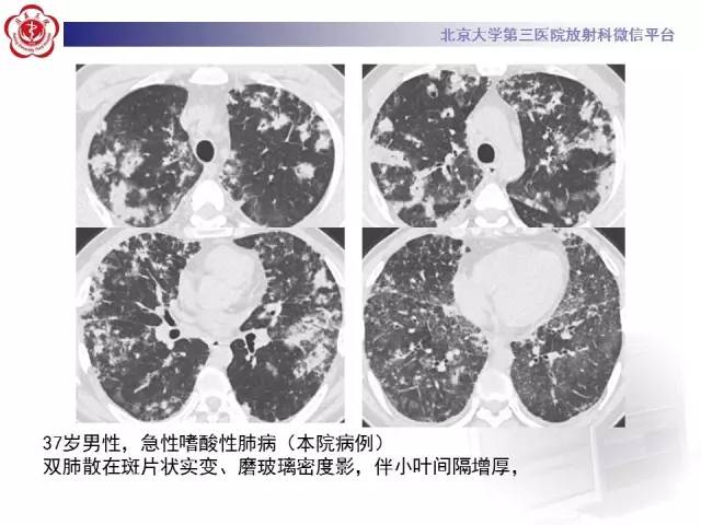 【PPT】磨玻璃密度病变的CT诊断（二）