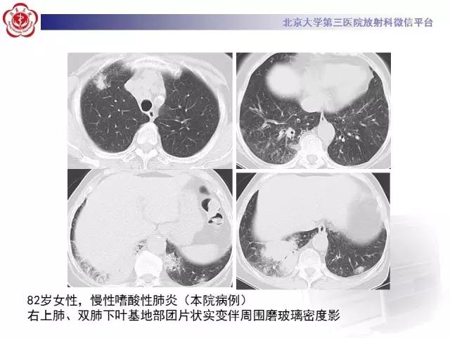 【PPT】磨玻璃密度病变的CT诊断（二）
