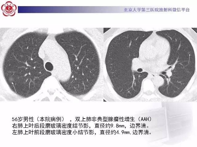 【PPT】磨玻璃密度病变的CT诊断（二）