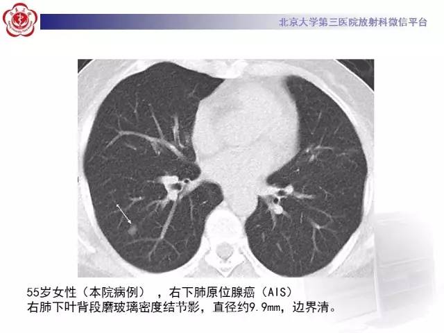 【PPT】磨玻璃密度病变的CT诊断（二）