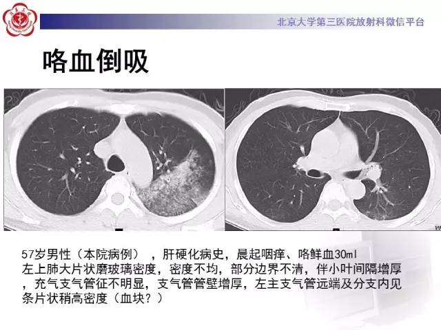 【PPT】磨玻璃密度病变的CT诊断（二）
