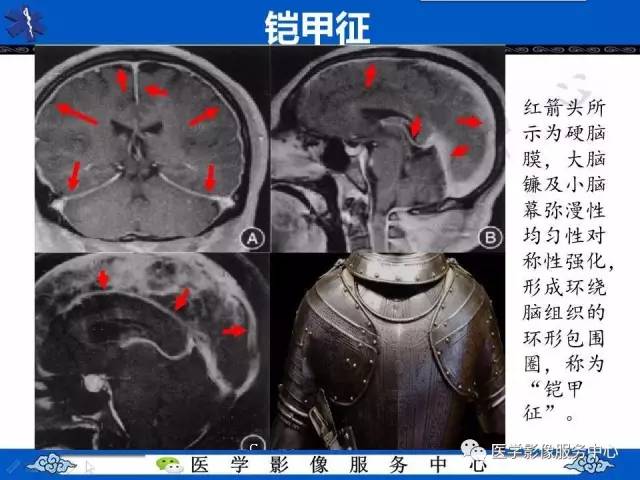 【影像征象】铠甲征