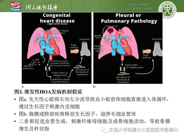 【PPT】肥大性骨关节病临床及影像特征【RG精选】