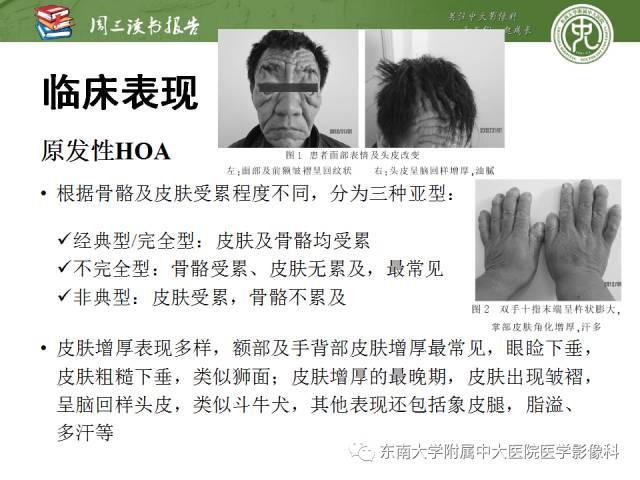 【PPT】肥大性骨关节病临床及影像特征【RG精选】