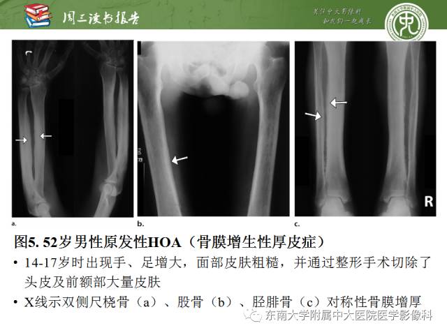 【PPT】肥大性骨关节病临床及影像特征【RG精选】