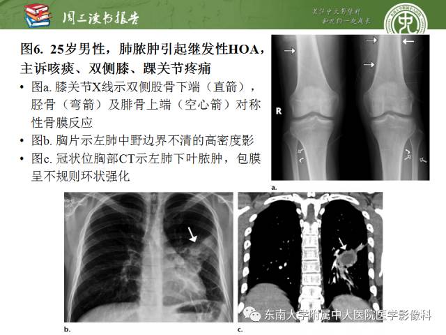 【PPT】肥大性骨关节病临床及影像特征【RG精选】