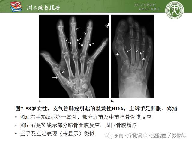 【PPT】肥大性骨关节病临床及影像特征【RG精选】