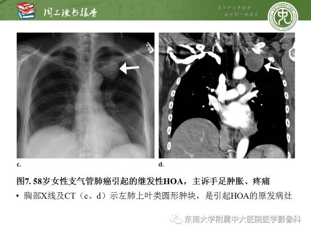 【PPT】肥大性骨关节病临床及影像特征【RG精选】