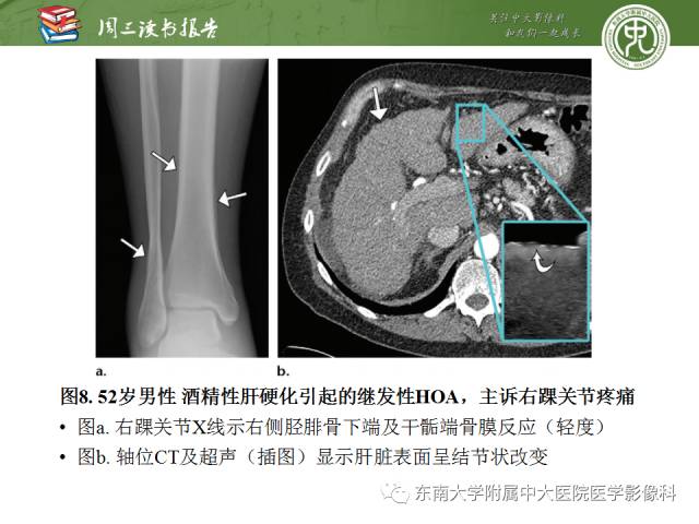【PPT】肥大性骨关节病临床及影像特征【RG精选】