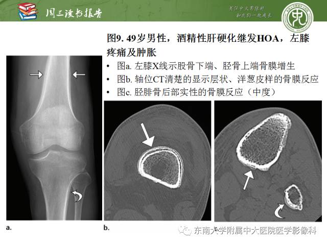 【PPT】肥大性骨关节病临床及影像特征【RG精选】