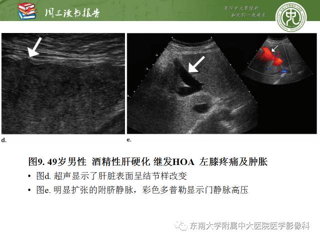 【PPT】肥大性骨关节病临床及影像特征【RG精选】