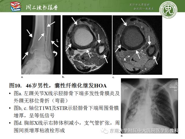 【PPT】肥大性骨关节病临床及影像特征【RG精选】