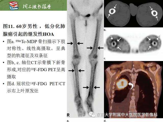 【PPT】肥大性骨关节病临床及影像特征【RG精选】