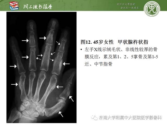 【PPT】肥大性骨关节病临床及影像特征【RG精选】