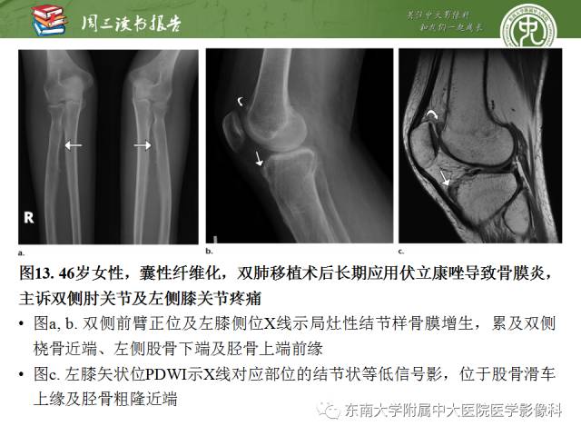 【PPT】肥大性骨关节病临床及影像特征【RG精选】
