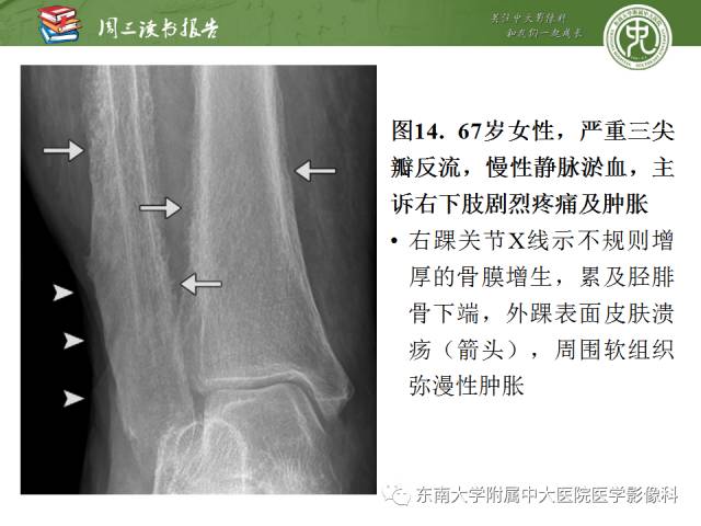 【PPT】肥大性骨关节病临床及影像特征【RG精选】