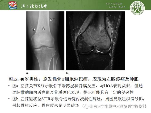 【PPT】肥大性骨关节病临床及影像特征【RG精选】