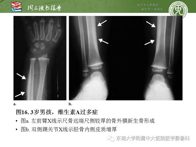 【PPT】肥大性骨关节病临床及影像特征【RG精选】