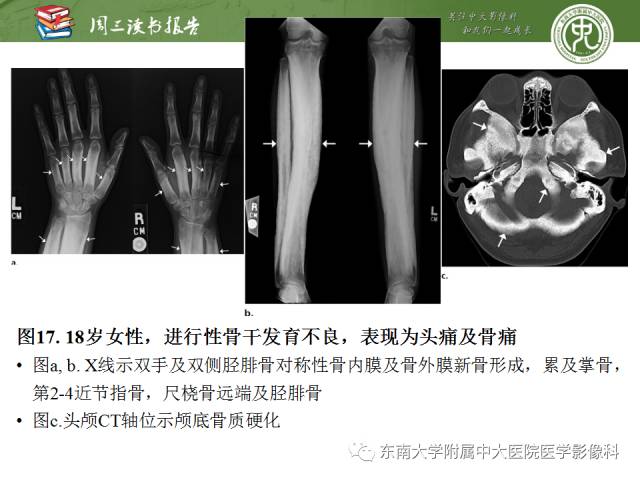 【PPT】肥大性骨关节病临床及影像特征【RG精选】