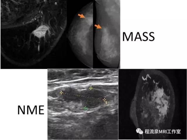 【PPT】乳腺非肿块样强化的鉴别诊断