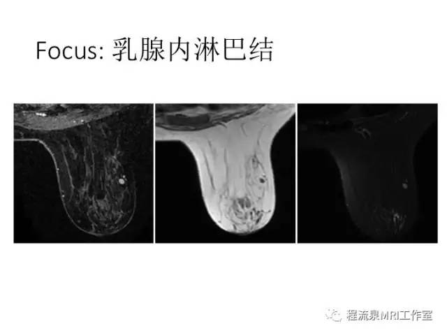 【PPT】乳腺非肿块样强化的鉴别诊断