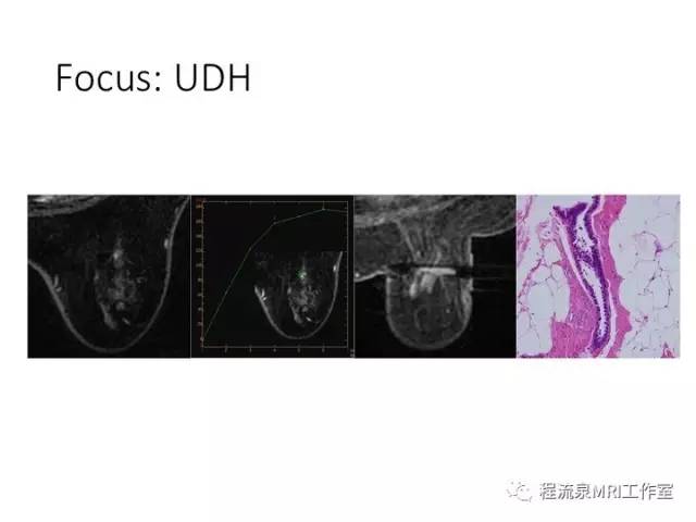 【PPT】乳腺非肿块样强化的鉴别诊断