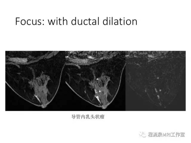 【PPT】乳腺非肿块样强化的鉴别诊断